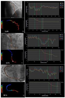 Novel Insights Into the Interaction Between the Autonomic Nervous System and Inflammation on Coronary Physiology: A Quantitative Flow Ratio Study